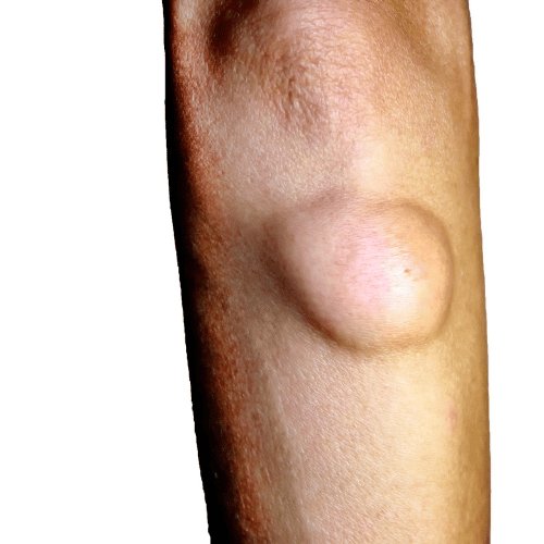 bőr alatti csomók lágyrész ultrahang vizsgálata